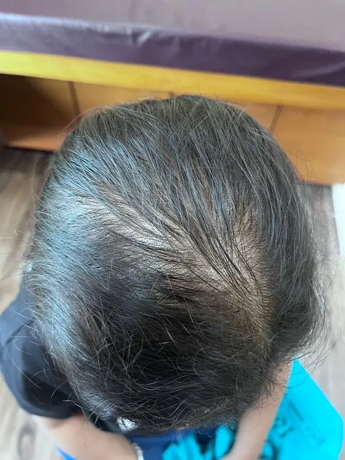 Female Pattern Baldness case 2 after treatment